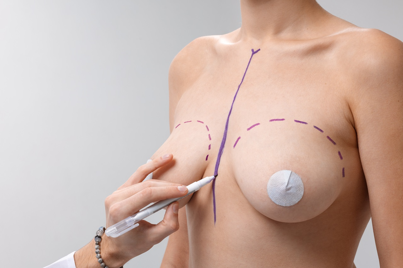 Mastopexia con implantes